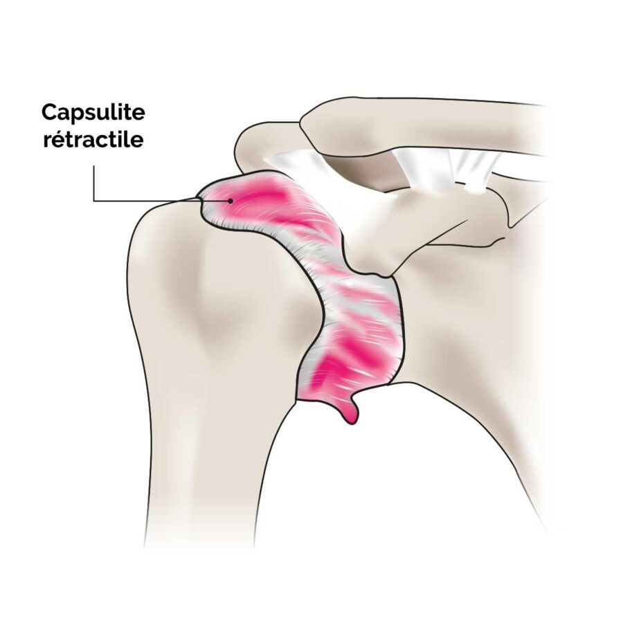 capsulite rétractile