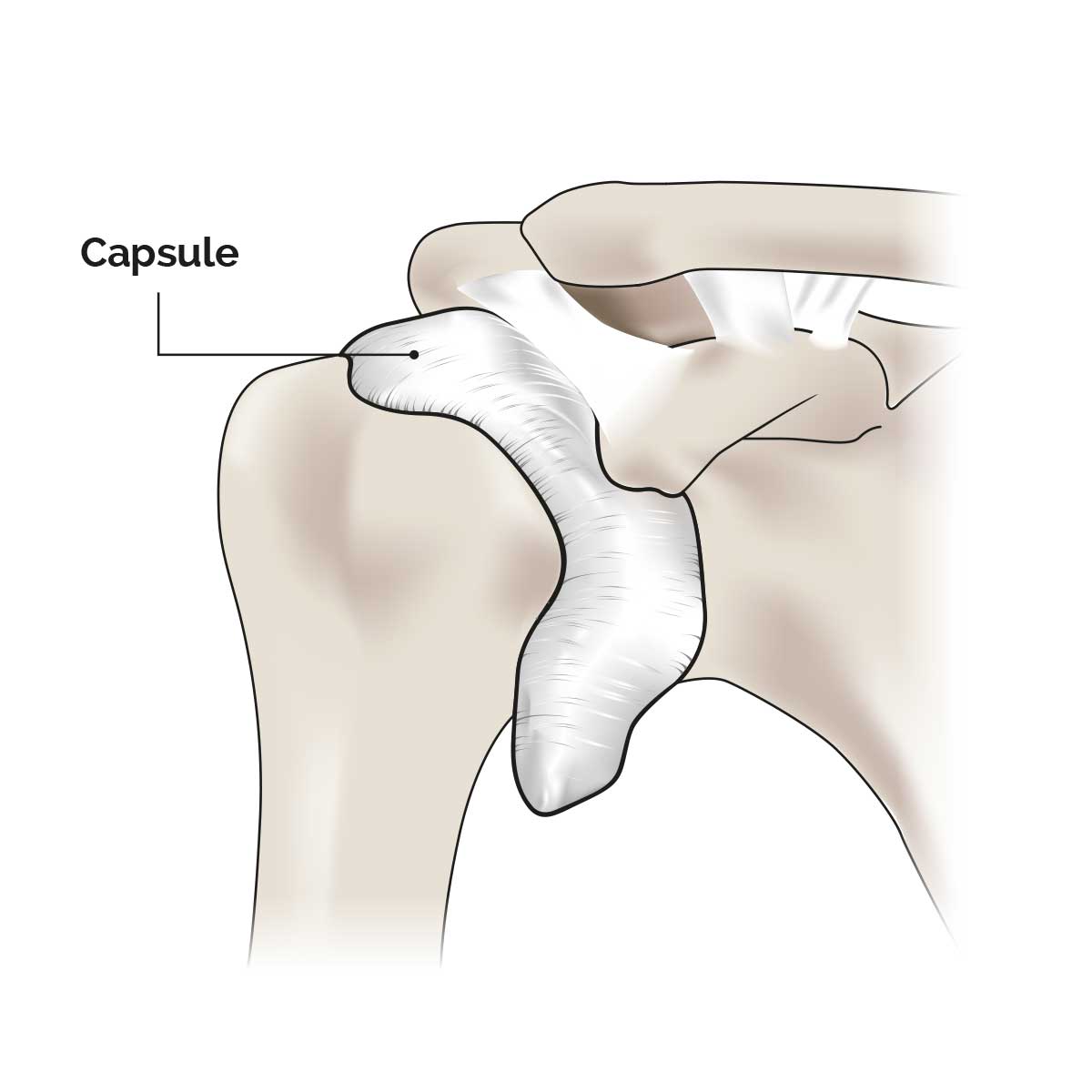 Capsulite L'épaule au TOP