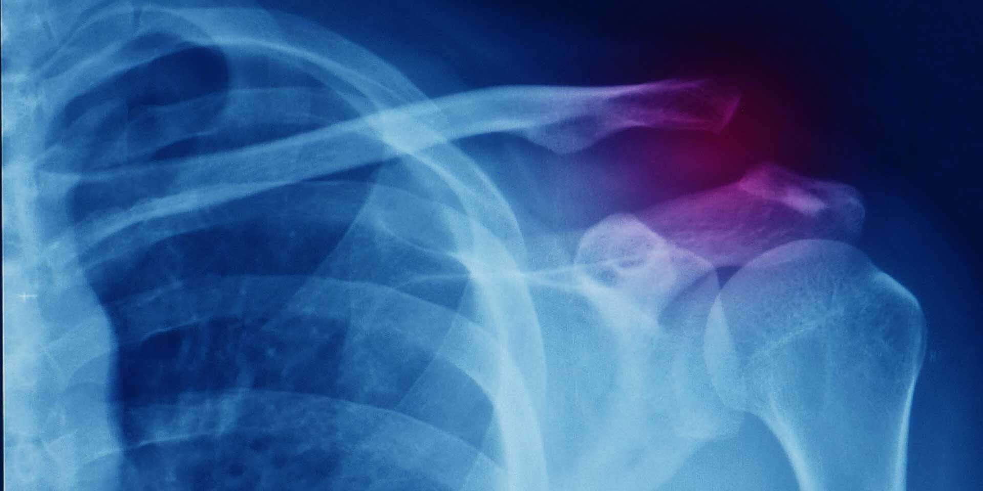 disjonction-acromio-claviculaire disjonction acromion-claviculaire