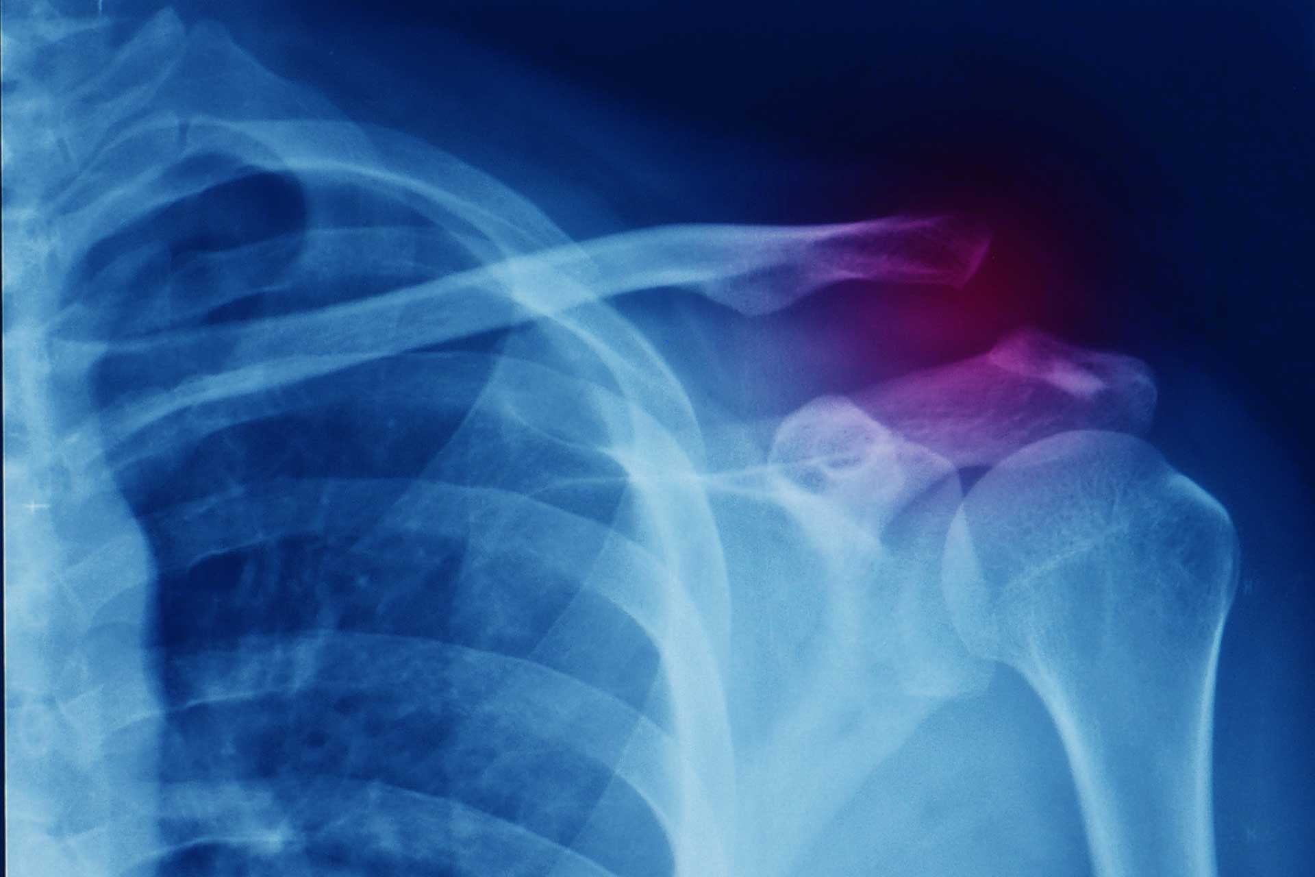 disjonction-acromio-claviculaire disjonction acromion-claviculaire