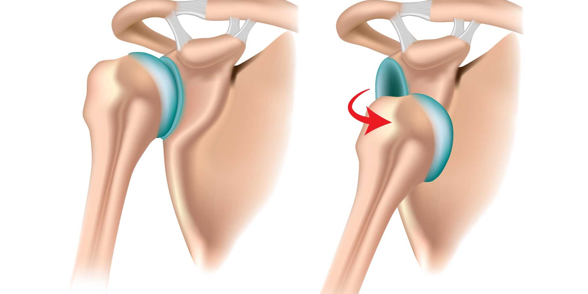 Luxation antérieure de l'épaule