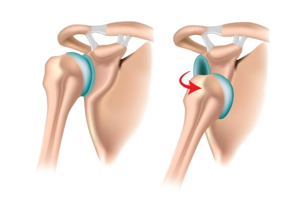 Luxation antérieure de l'épaule