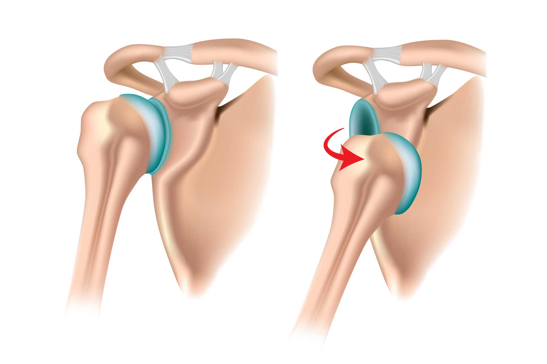 luxation-anterieure-epaule-2 Luxation antérieure de l'épaule