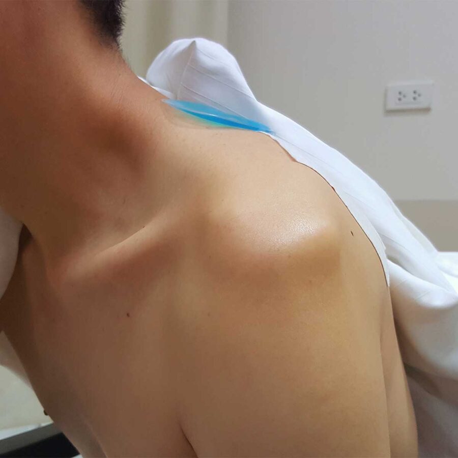 Patient épaule luxée