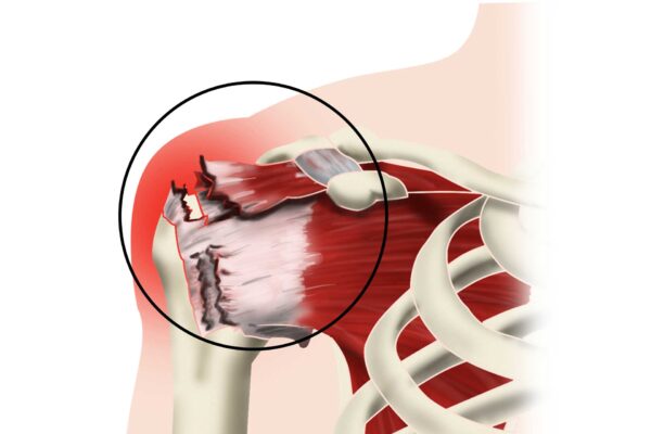 Opérer une rupture de coiffe des rotateurs