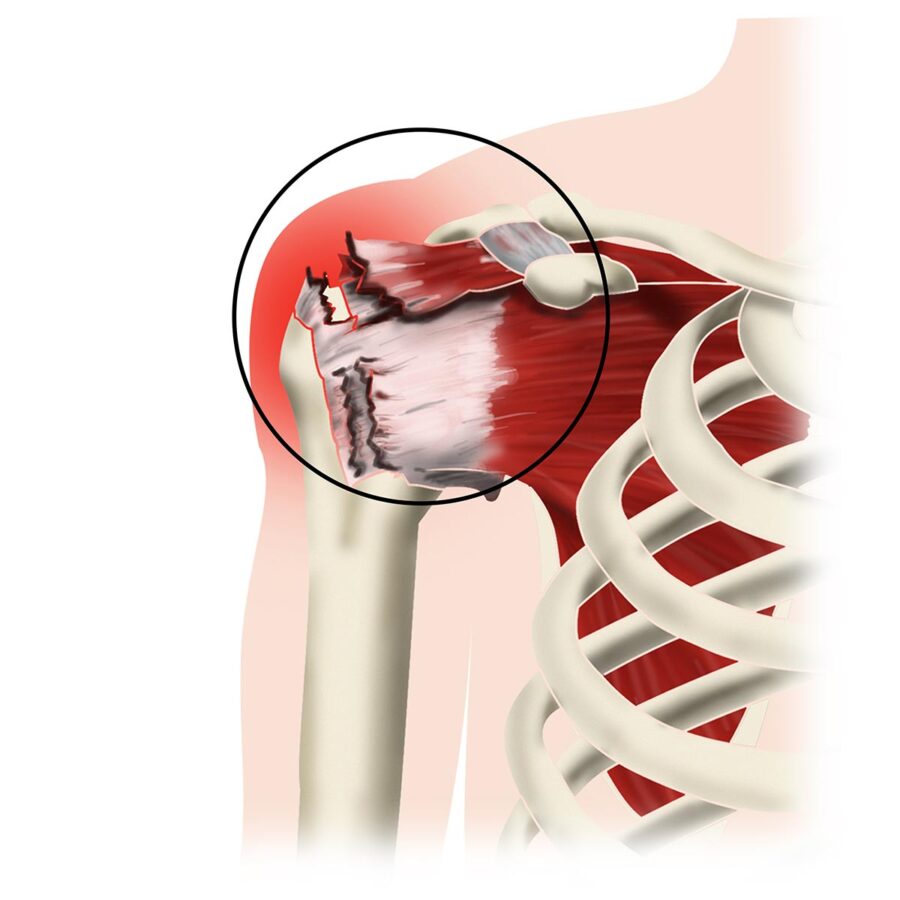 La rupture des tendons de la coiffe des rotateurs est la plus fréquente du corps