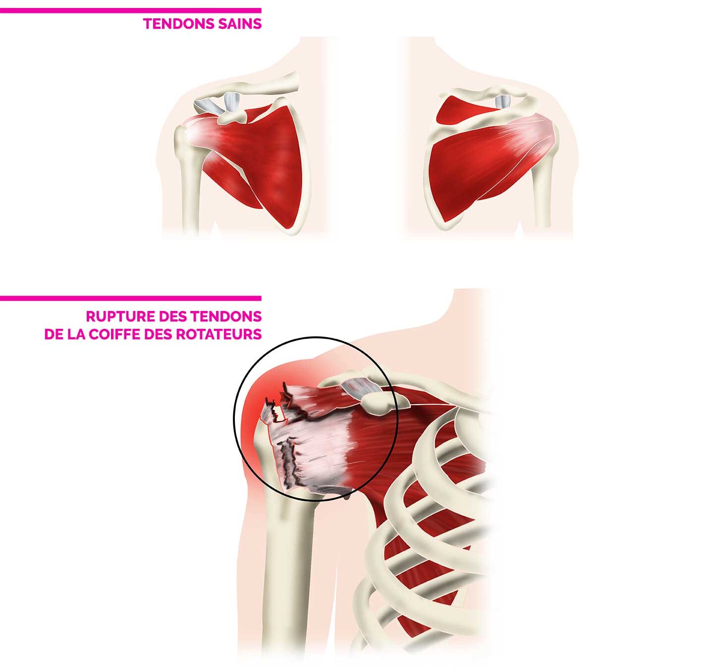 traitement rupture tendons de la coiffe des rotateurs